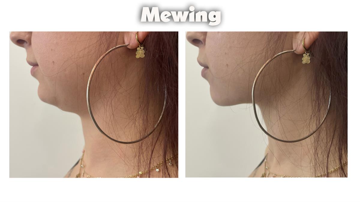 Mewing': la técnica para 'cambiar' la forma de la cara